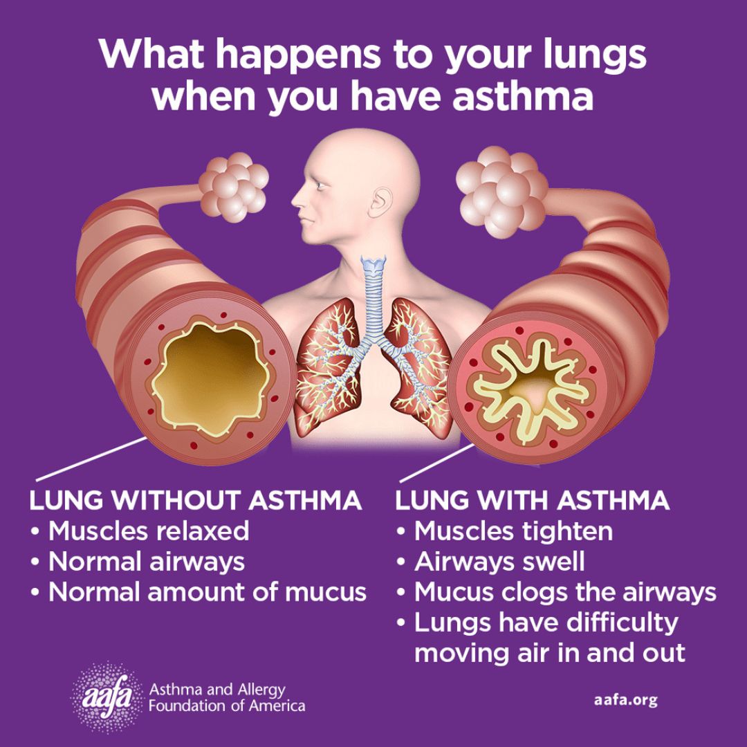 Image comparing healthy lungs to lungs with asthma. On the left is a normal airways that is open and relaxed with normal muscle tone and mucus. On the right is an airway with asthma with narrowed, tight muscles, swollen walls, and excess mucous. A human figure is show in the center and the text explains that asthma makes it harder to for air to move in and out of the lungs. 